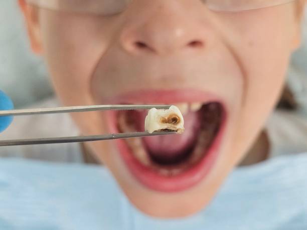 Best Emergency Dentist for Lost Fillings or Crowns in Lowell, AR
